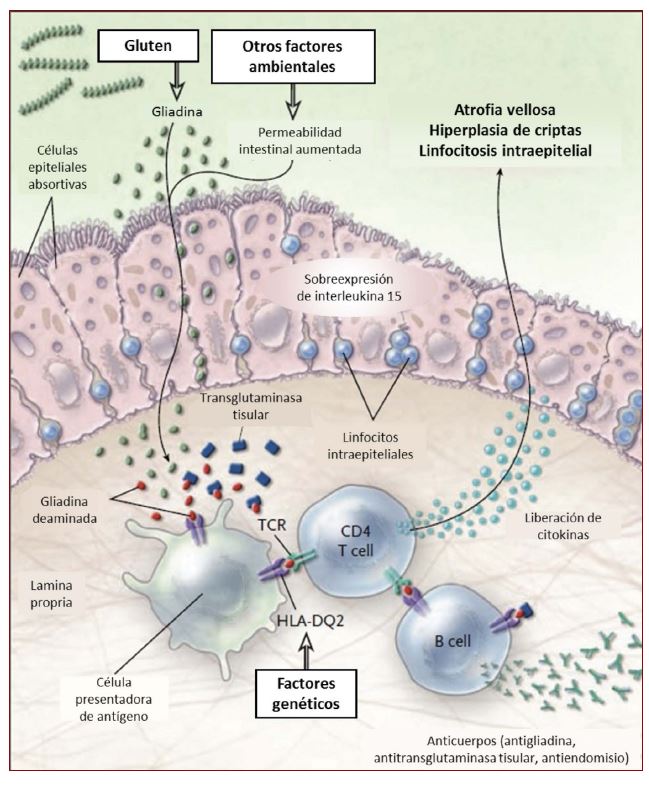 ENF.CELIACA.FISIOPATOLOGIA.jpg